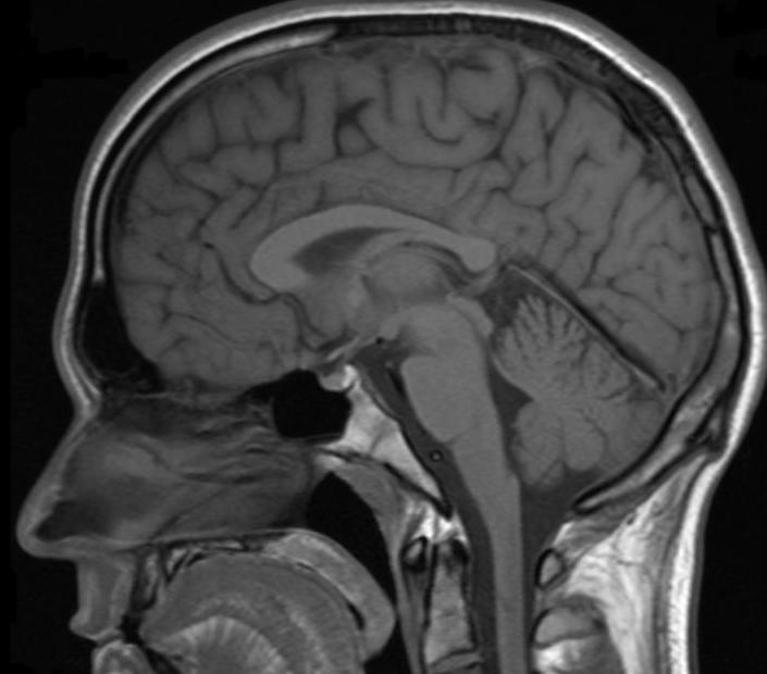 Que se detecta en una resonancia magnetica cerebral